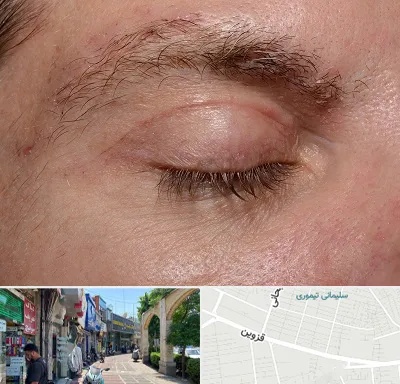 جراح بلفاروپلاستی در خیابان قزوین