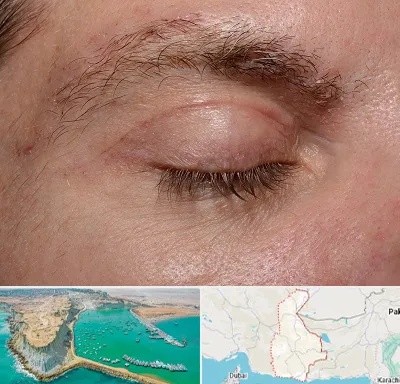 جراح بلفاروپلاستی در سیستان و بلوچستان
