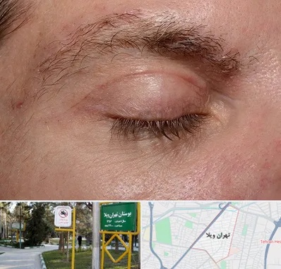 جراح بلفاروپلاستی در تهران ویلا