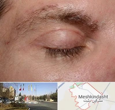 جراح بلفاروپلاستی در مشکین دشت