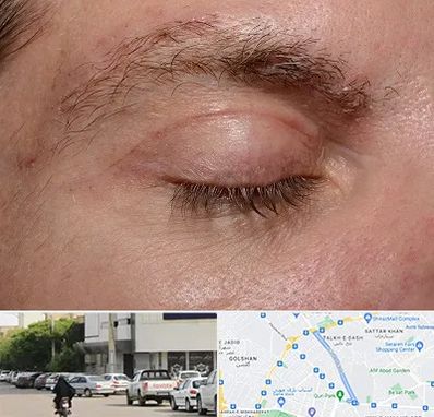 جراح بلفاروپلاستی در قدوسی شرقی شیراز