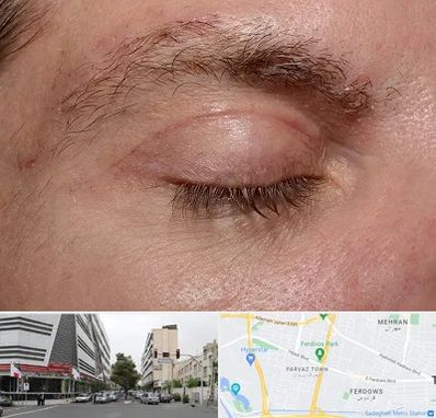 جراح بلفاروپلاستی در بلوار فردوس 