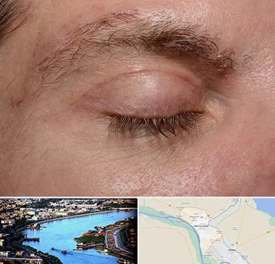 جراح بلفاروپلاستی در خرمشهر