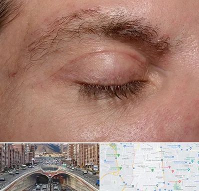 جراح بلفاروپلاستی در منطقه 10 تهران 