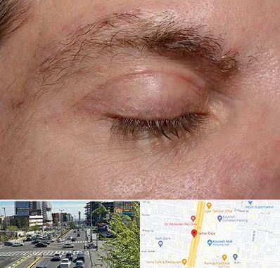 جراح بلفاروپلاستی در ستاری 