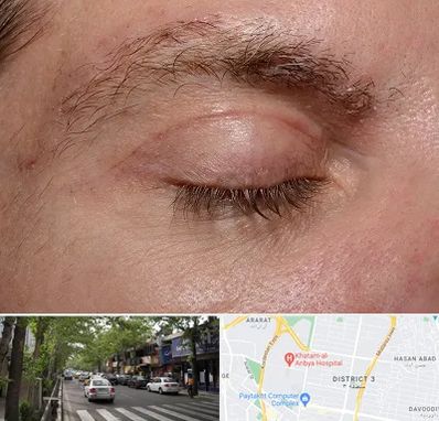 جراح بلفاروپلاستی در ظفر 