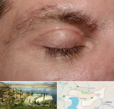 جراح بلفاروپلاستی در شبستر