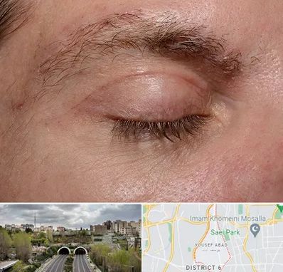 جراح بلفاروپلاستی در یوسف آباد 
