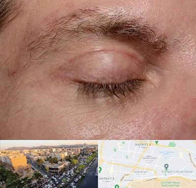 جراح بلفاروپلاستی در تهرانپارس 