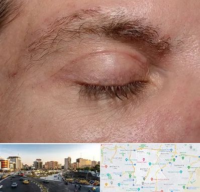 جراح بلفاروپلاستی در منطقه 7 تهران 