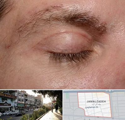 جراح بلفاروپلاستی در خیابان جمالزاده