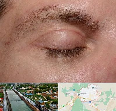 جراح بلفاروپلاستی در مراغه