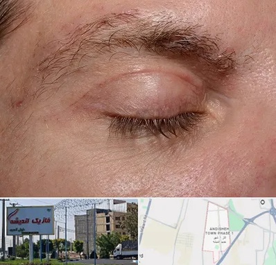 جراح بلفاروپلاستی در فاز یک اندیشه
