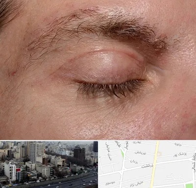 جراح بلفاروپلاستی در زرتشت