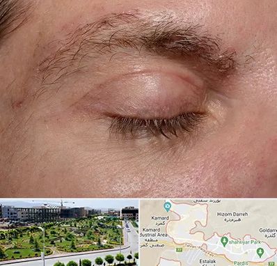جراح بلفاروپلاستی در پردیس