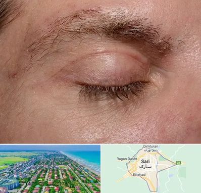جراح بلفاروپلاستی در ساری