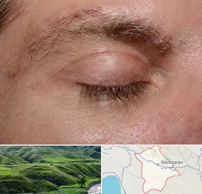 جراح بلفاروپلاستی در گچساران