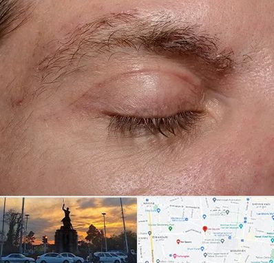 جراح بلفاروپلاستی در میدان حر 