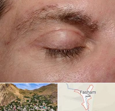 جراح بلفاروپلاستی در فشم