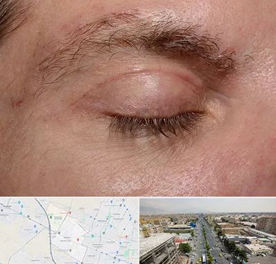 جراح بلفاروپلاستی در حصارک کرج