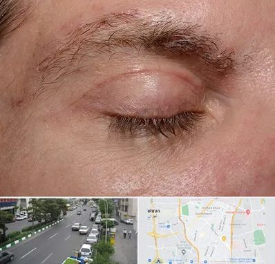 جراح بلفاروپلاستی در ستارخان 