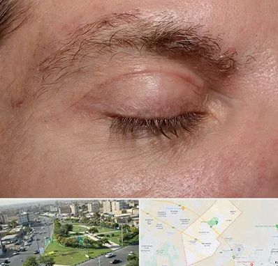 جراح بلفاروپلاستی در کمال شهر کرج 