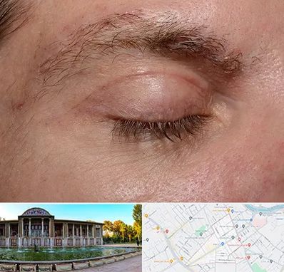 جراح بلفاروپلاستی در عفیف آباد شیراز