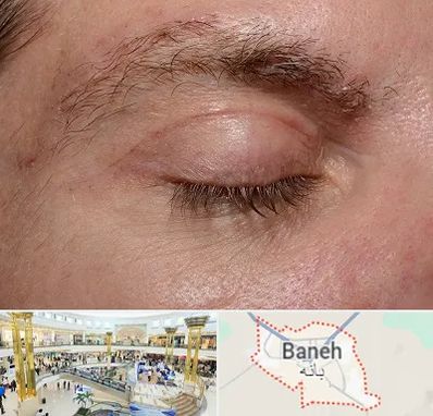 جراح بلفاروپلاستی در بانه