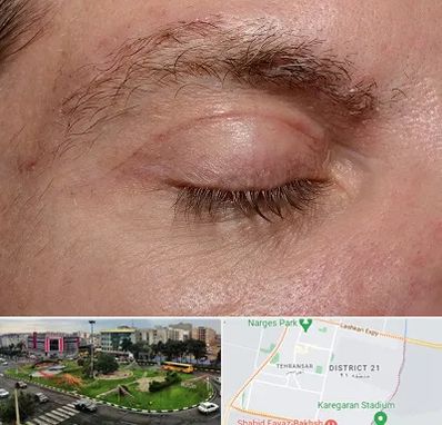 جراح بلفاروپلاستی در تهرانسر 