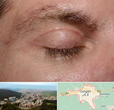 جراح بلفاروپلاستی در گرگان