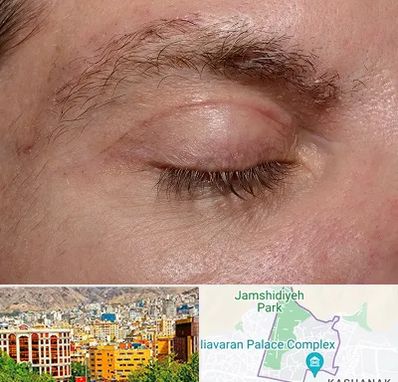 جراح بلفاروپلاستی در نیاوران 