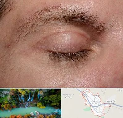 جراح بلفاروپلاستی در دورود