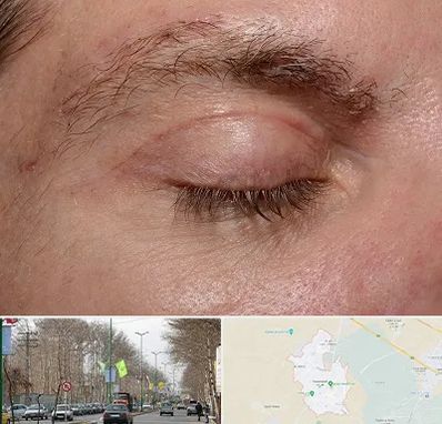 جراح بلفاروپلاستی در نظرآباد کرج 