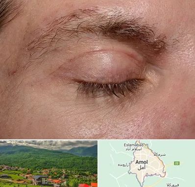 جراح بلفاروپلاستی در آمل