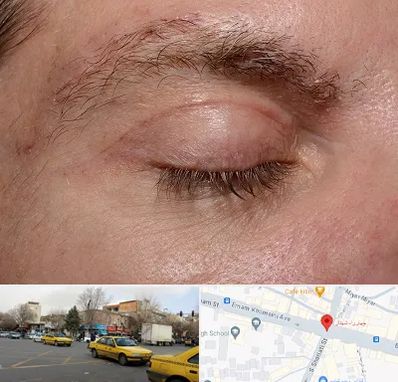 جراح بلفاروپلاستی در شهناز تبریز