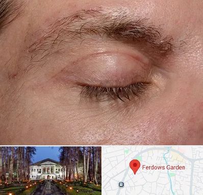جراح بلفاروپلاستی در باغ فردوس