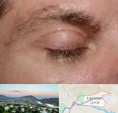 جراح بلفاروپلاستی در لواسان