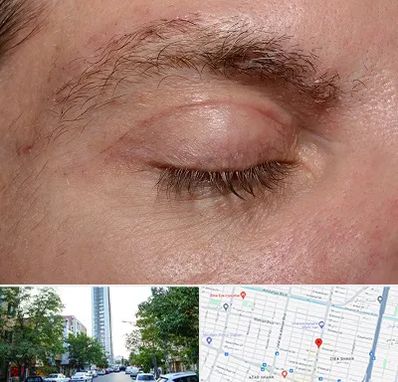 جراح بلفاروپلاستی در امامت مشهد