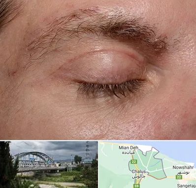 جراح بلفاروپلاستی در چالوس