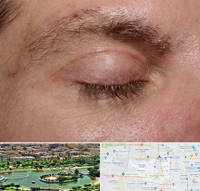 جراح بلفاروپلاستی در منطقه 9 تهران 