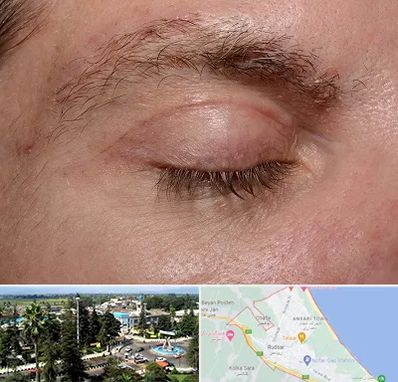 جراح بلفاروپلاستی در رودسر