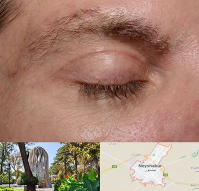جراح بلفاروپلاستی در نیشابور