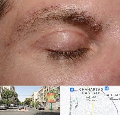 جراح بلفاروپلاستی در چهارصد دستگاه 