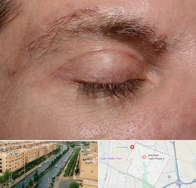 جراح بلفاروپلاستی در فاز سه اندیشه
