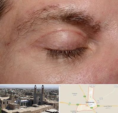 جراح بلفاروپلاستی در سبزوار