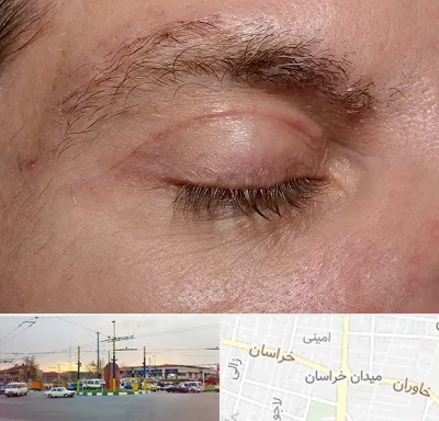 جراح بلفاروپلاستی در میدان خراسان