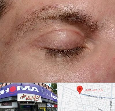 جراح بلفاروپلاستی در امین حضور