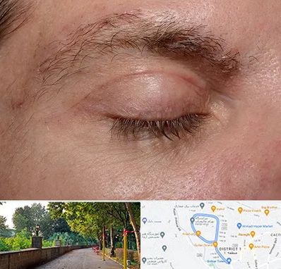 جراح بلفاروپلاستی در فلکه گاز رشت