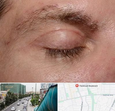 جراح بلفاروپلاستی در بلوار فرحزادی