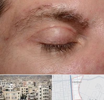 جراح بلفاروپلاستی در اسکندری